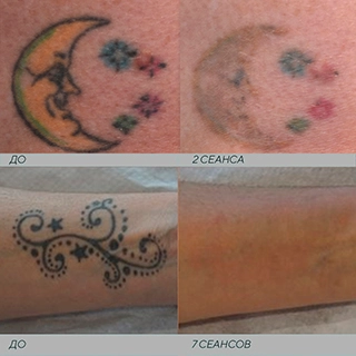 Фото до и после выведение татуировки лазером
